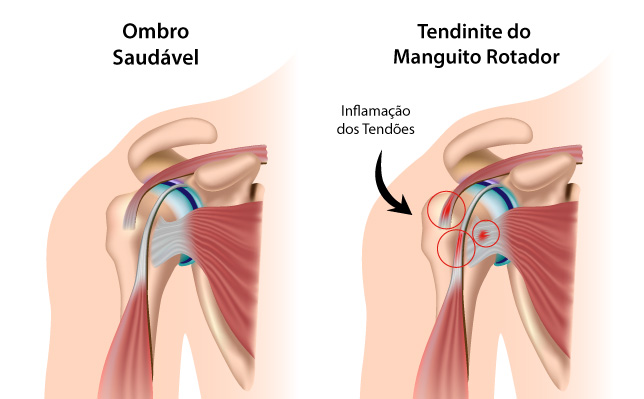 Tendinite No Ombro Dr F Bio Pizzo Ribeiro