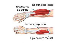 Epicondilite Lateral e Medial