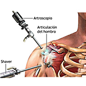 Cirurgia Artroscópica de Ombro